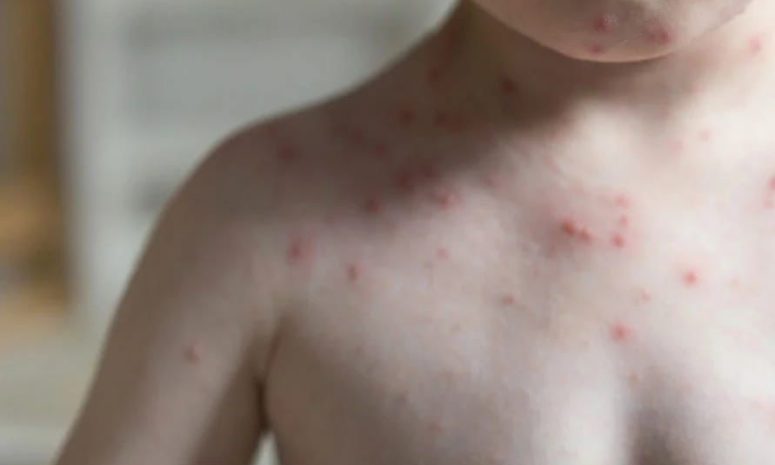 Cerco epidemiológico en Maravatío por brote de sarampión