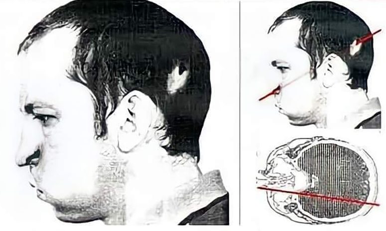 El hombre que sobrevivió a un haz de protones que atravesó su cabeza