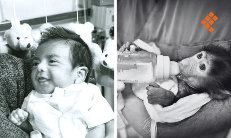 Baby Fae, la bebé que recibió un trasplante de corazón de babuino